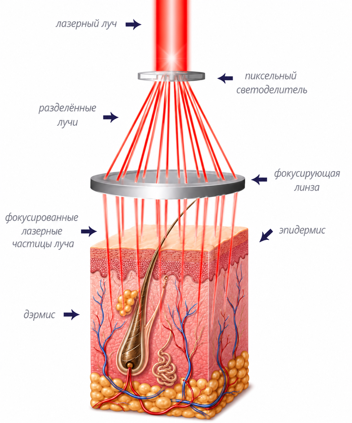 фракционный лазер