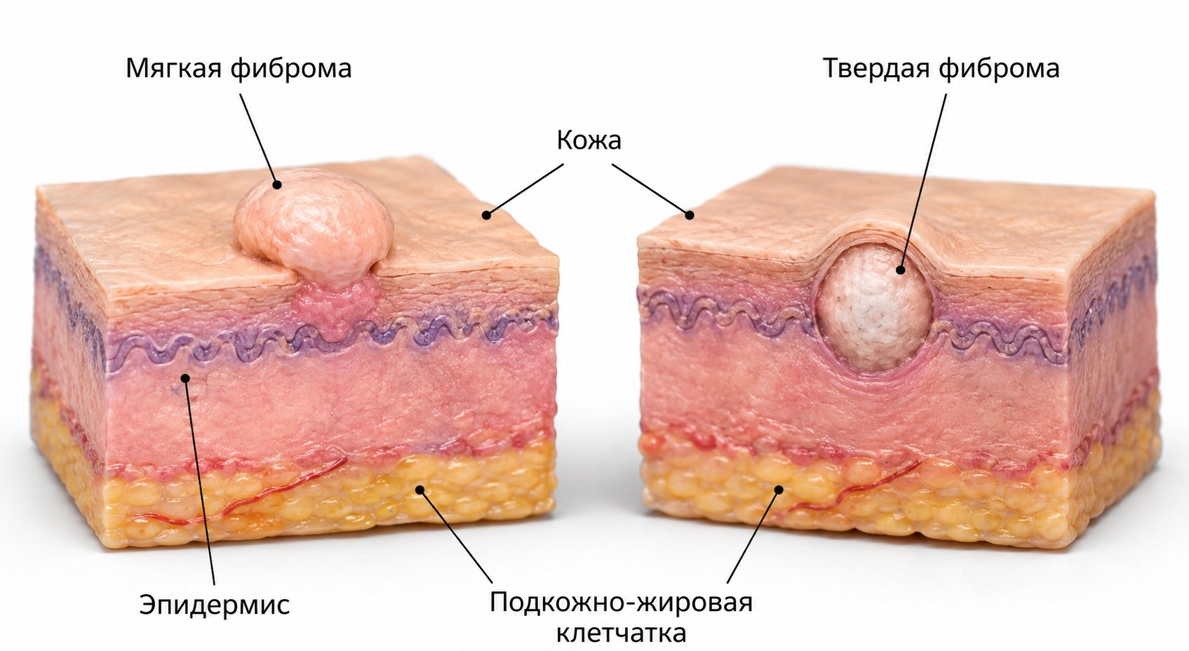 фиброма