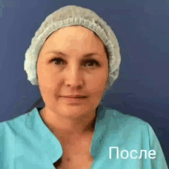 Через неделю после инъекций ботулотоксина инъекции ботулотоксина
